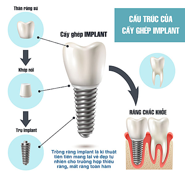 Trồng răng Implant (cấy ghép implant) là gì?