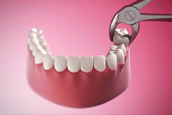 Có nên nhổ và trồng răng hàm không?