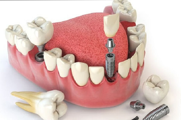 Giá trồng răng hàm Implant?