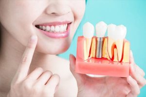 Răng Implant bị lung lay xử lý làm sao cho DỨT ĐIỂM vĩnh viễn?
