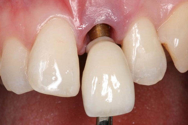 Răng Implant bị lung lay do lỏng vít kết nối