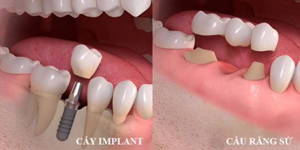 So sánh Trồng răng Implant với các phương pháp bắc cầu răng sứ
