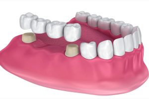Trồng răng hàm bằng cách cầu răng sứ