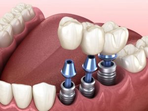 Trồng răng Implant có nguy hiểm không và yếu tố nào ảnh hưởng?