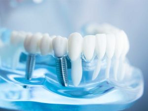 Trồng răng Implant giá rẻ TRỌN GÓI, bảo hành vĩnh viễn