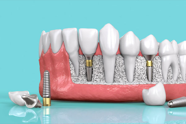 Trồng răng Implant trả góp ở đâu tốt, cần điều kiện gì? 