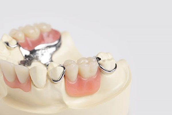 Giá trồng răng hàm tháo lắp?
