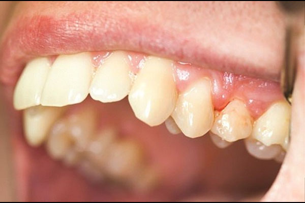 Răng Implant bị lung lay có thể do viêm nha chu