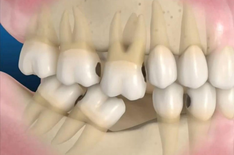 Mất răng: Nguyên nhân, hậu quả và những cách khắc phục hiện nay