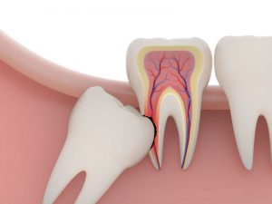 Răng khôn là gì? Có nên nhổ răng khôn không?