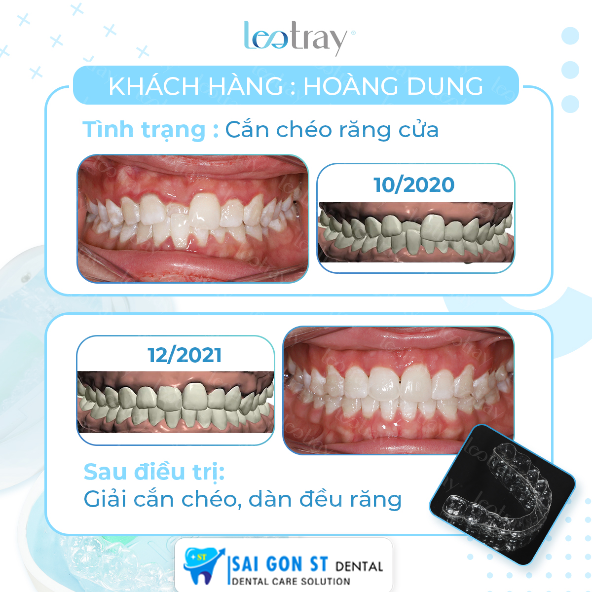 25 tháng trải nghiệm dịch vụ niềng răng trong suốt tại nha khoa Sài Gòn S.T giúp chị Lương Gia Hân đạt được kết quả ngoài mong đợi