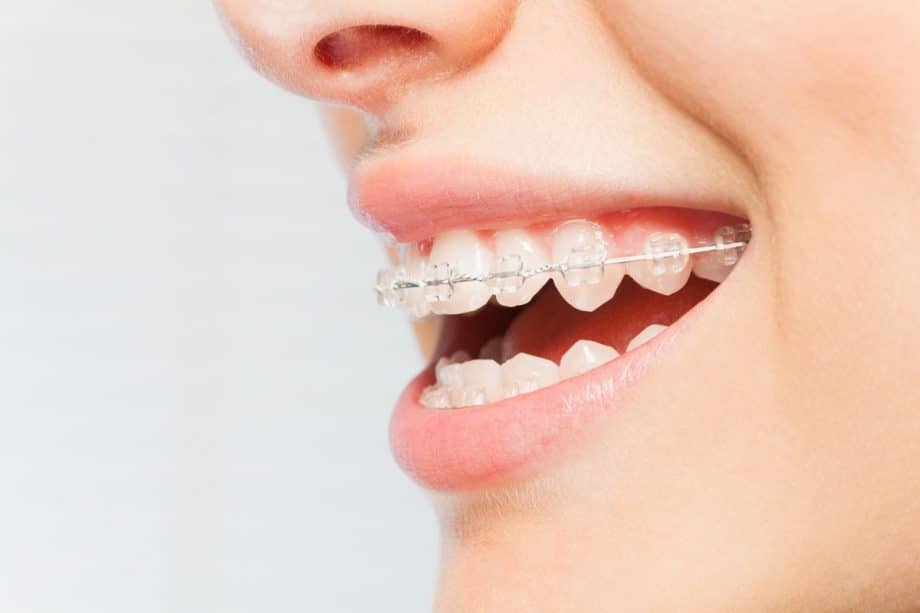 Niềng răng thẩm mỹ là một trong những dịch vụ nha khoa phổ biến hiện nay
