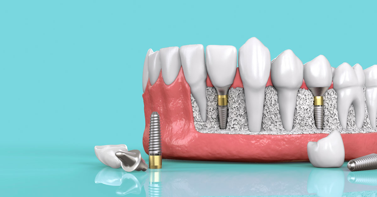 Răng Implant