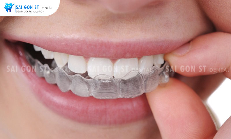Niềng răng trong suốt mang đến tính thẩm mỹ cao và thoải mái trong quá trình điều trị