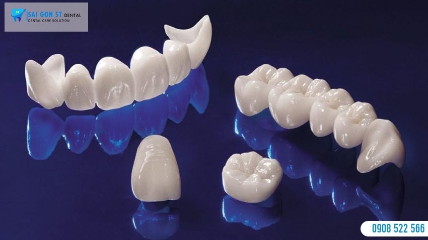 Bọc Răng Sứ Loại Nào Tốt 5 Điều Cần Lưu Ý Khi Lựa Chọn Răng Sứ Phù Hợp (4)