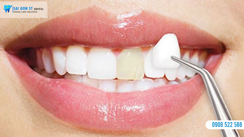 Chia Sẻ Kinh Nghiệm Dán Sứ Veneer Bạn Cần Biết