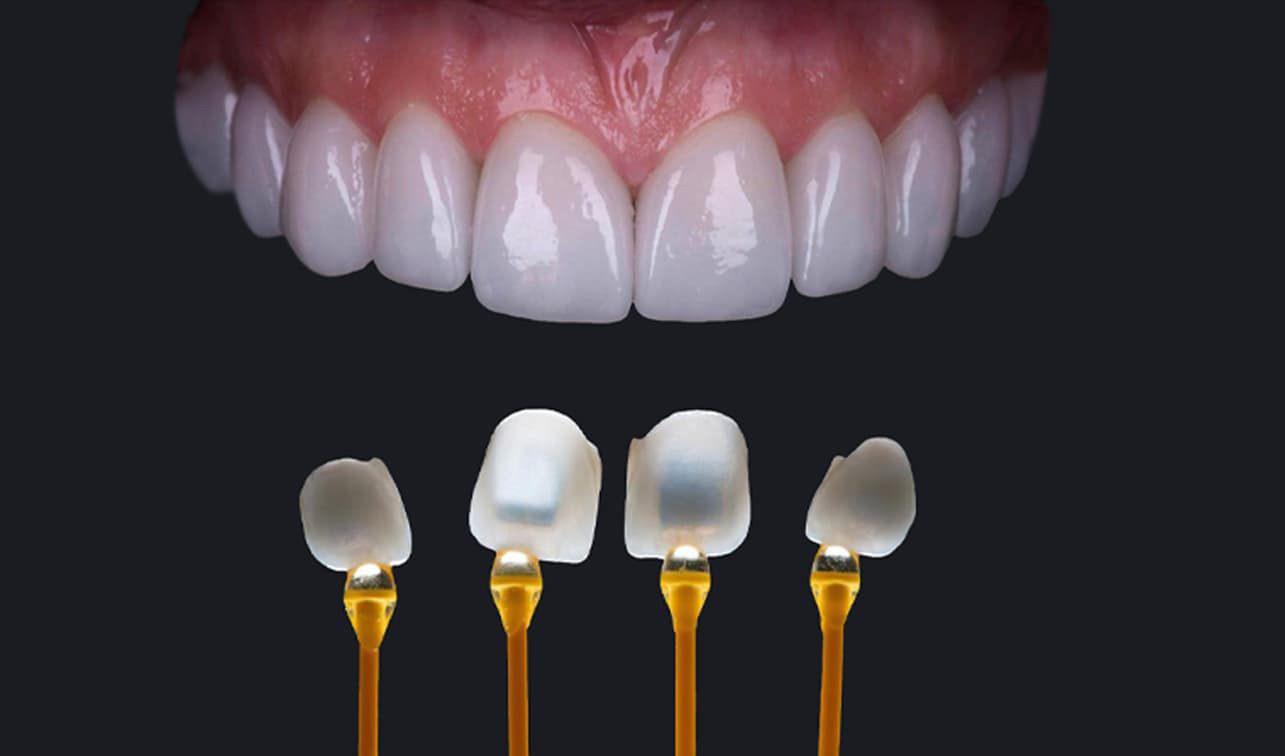 Chia Sẻ Kinh Nghiệm Dán Sứ Veneer Bạn Cần Biết