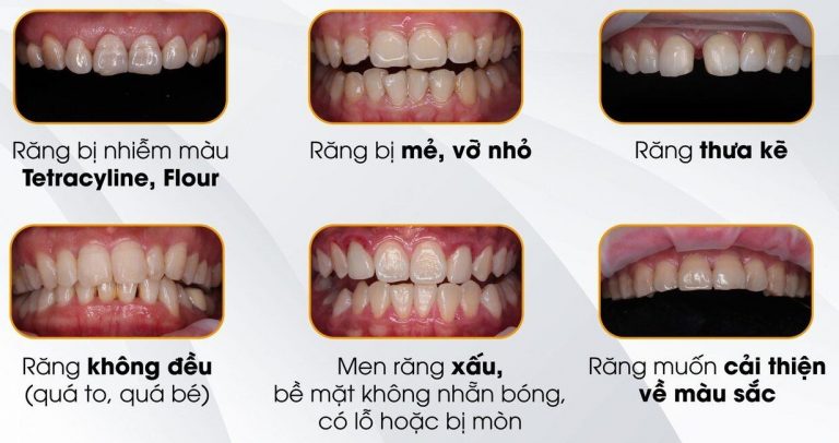 Dán Sứ Veneer Là Gì Chi Phí Như Thế Nào Quy Trình Thực Hiện Chi Tiết (1)