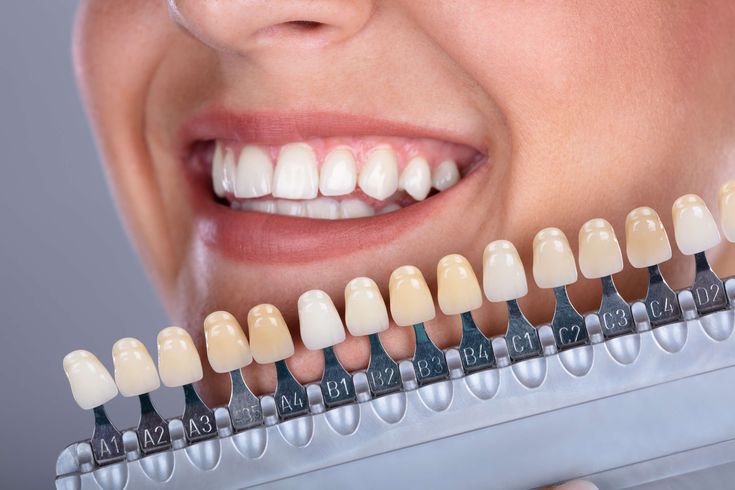 Dán Sứ Veneer Là Gì Chi Phí Như Thế Nào Quy Trình Thực Hiện Chi Tiết (4)