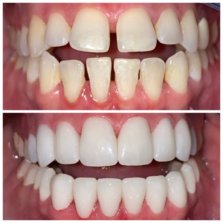 Dán Sứ Veneer Là Gì Chi Phí Như Thế Nào Quy Trình Thực Hiện Chi Tiết