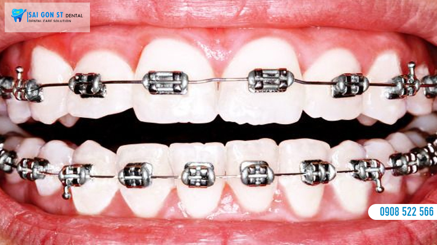 Niềng Răng Mắc Cài Kim Loại Là Gì Chi Phí Bao Nhiêu