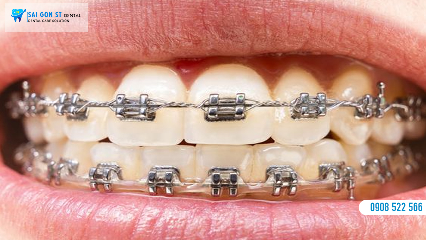 Niềng Răng Mắc Cài Kim Loại Là Gì Chi Phí Bao Nhiêu