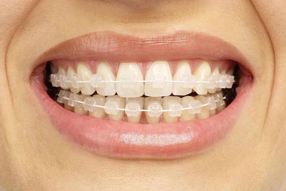 Niềng Răng Mắc Cài Sứ Là Gì Chi Phí Và Thời Gian Niềng Bao Lâu