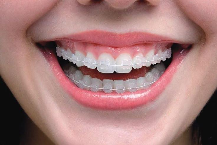 Niềng Răng Mắc Cài Sứ Là Gì Chi Phí Và Thời Gian Niềng Bao Lâu
