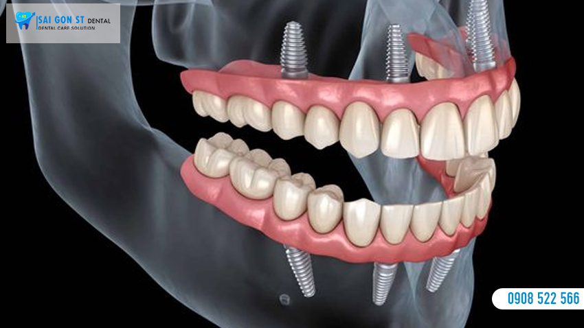 Trồng Răng Implant All On 4 Là Gì Có Nên Thực Hiện Không