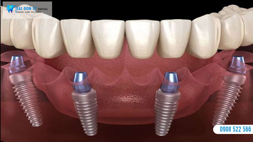 Trồng Răng Implant All On 4 Là Gì Có Nên Thực Hiện Không
