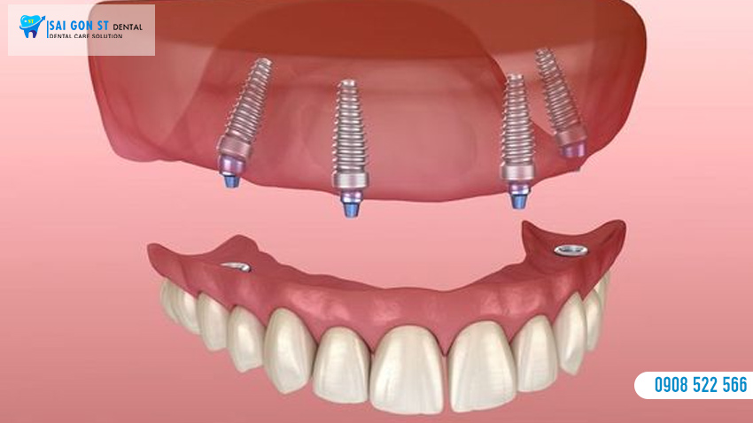Trồng Răng Implant All On 4 Là Gì Có Nên Thực Hiện Không