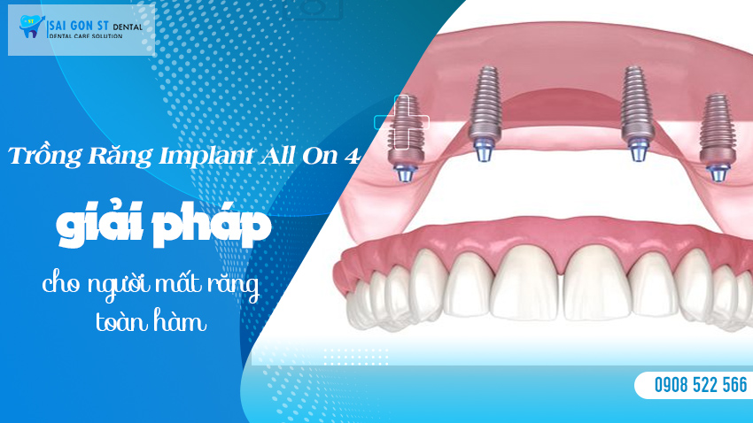 Trồng-răng-implant-all-on-4