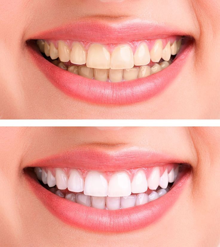 Hướng Dẫn Chăm Sóc Sau Khi Tẩy Trắng Răng