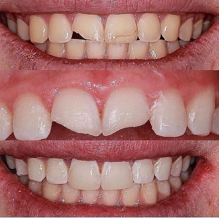 17 Tuổi Có Nên Bọc Răng Sứ Những Điều Cần Cân Nhắc Trước Khi Thực Hiện (3)