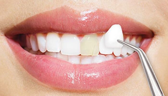 17 Tuổi Có Nên Bọc Răng Sứ Những Điều Cần Cân Nhắc Trước Khi Thực Hiện (5)