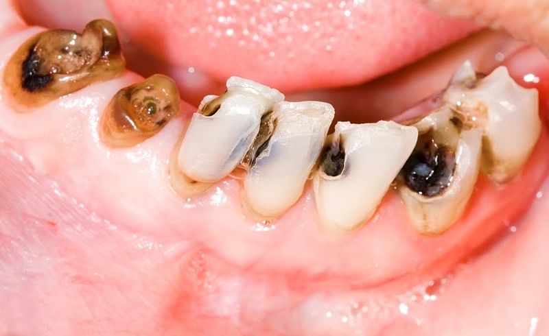 17 Tuổi Có Nên Bọc Răng Sứ Những Điều Cần Cân Nhắc Trước Khi Thực Hiện