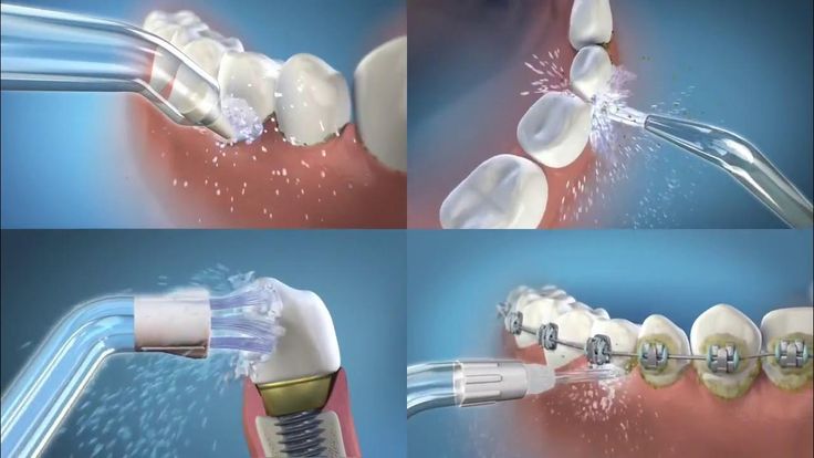 5 NguyÊn NhÂn GÂy Ê BuỐt Sau Khi LẤy Cao RĂng
