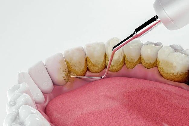 5 NguyÊn NhÂn GÂy Ê BuỐt Sau Khi LẤy Cao RĂng