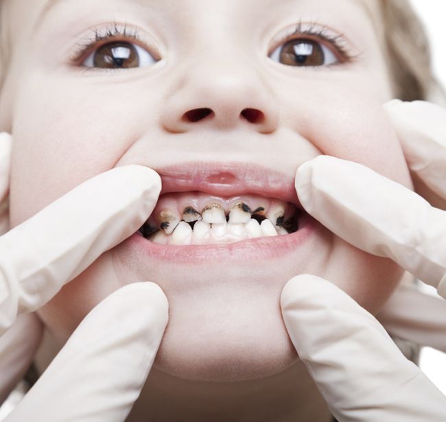Cách Nhổ Răng Sữa Cho Bé An Toàn, Không Đau & Đúng Thời Điểm Phụ Huynh Nên Biết (1)