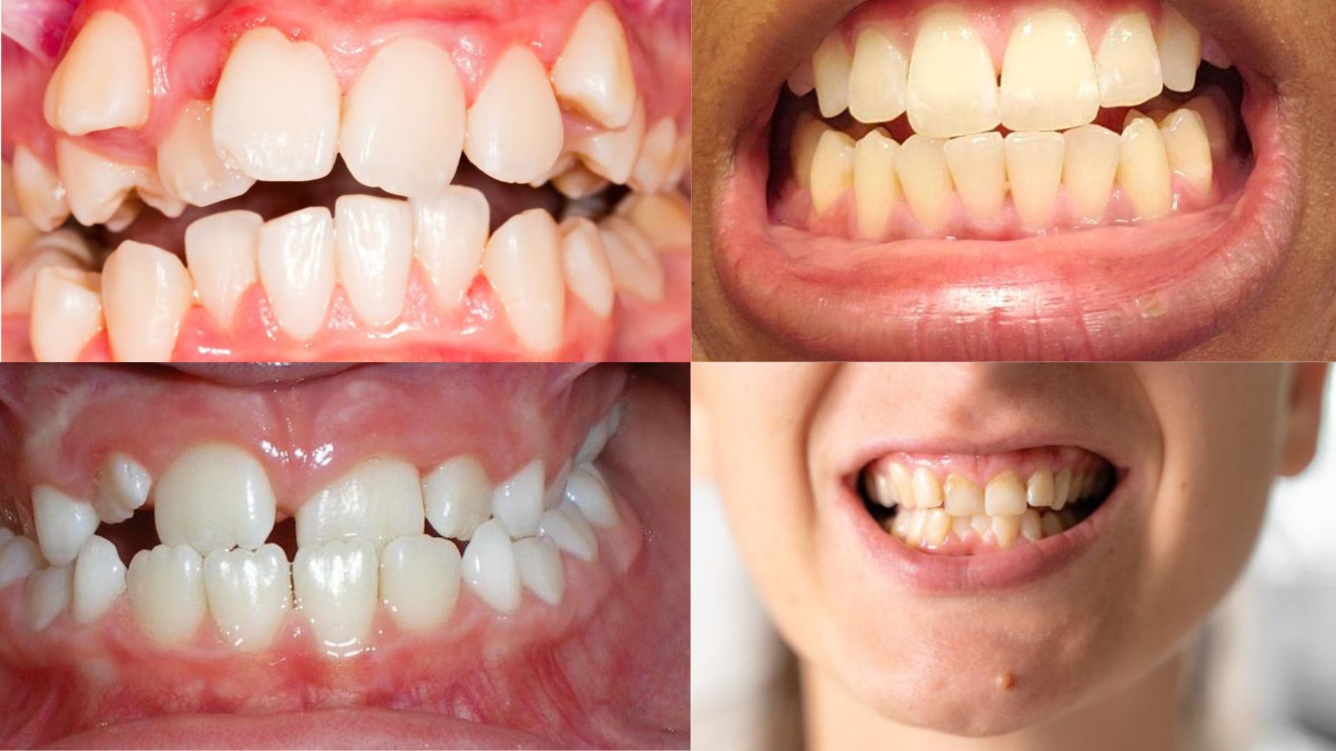 Chỉnh Nha Là Gì Các Phương Pháp Chỉnh Nha Hiện Nay