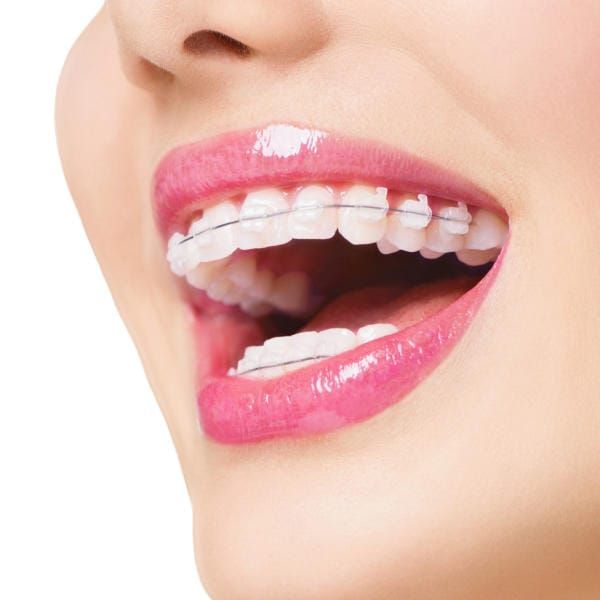 Chỉnh Nha Là Gì Các Phương Pháp Chỉnh Nha Hiện Nay