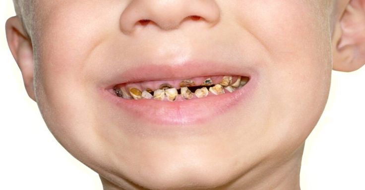 Sún Răng Ở Trẻ, Nguyên Nhân, Dấu Hiệu Và Cách Xử Lý Hiệu Quả (2)