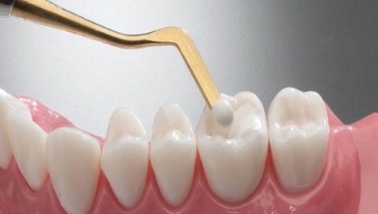 Trám Răng Là Gì Quy Trình Thực Hiện Và Những Điều Cần Biết