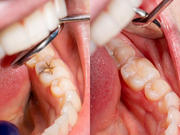 Trám Răng Là Gì Quy Trình Thực Hiện Như Thế Nào