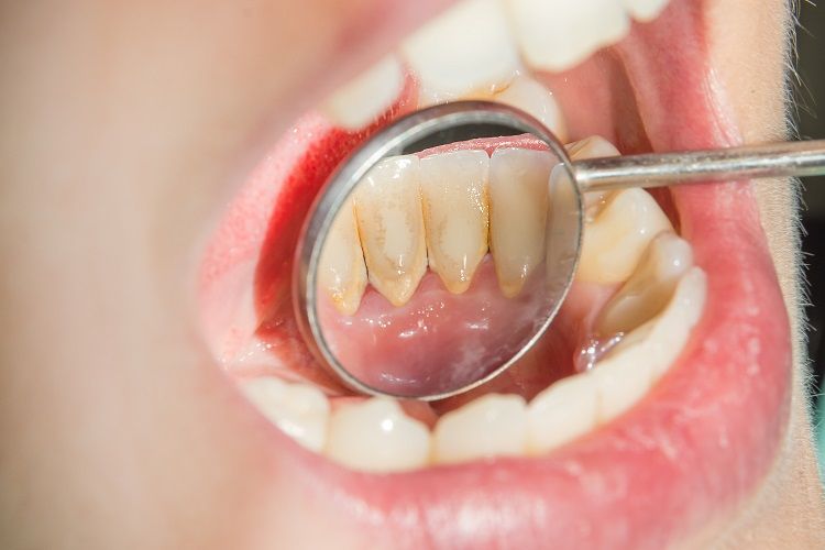 Cạo Vôi Răng Làm Răng Yếu – Sự Thật Hay Hiểu Lầm Tai Hại
