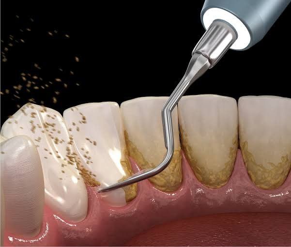 Cạo Vôi Răng Làm Răng Yếu – Sự Thật Hay Hiểu Lầm Tai Hại