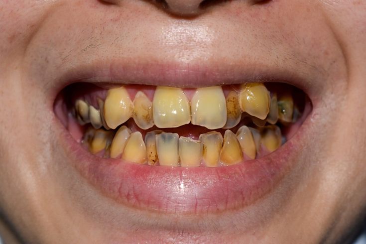 Dấu Hiệu Răng Sâu Vào Tủy – Tác Hại Và Cách Điều Trị