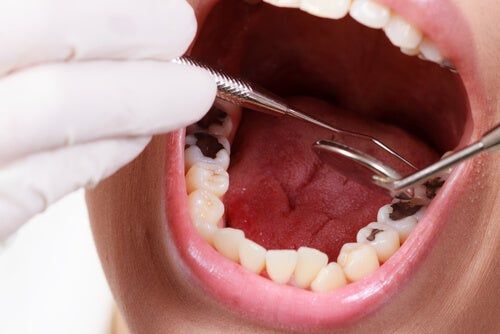 Dấu Hiệu Răng Sâu Vào Tủy – Tác Hại Và Cách Điều Trị