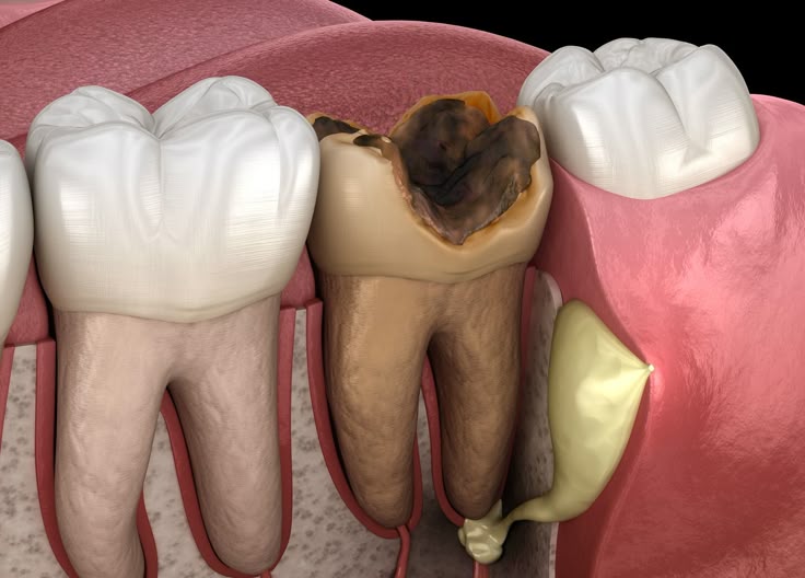 Dấu Hiệu Răng Sâu Vào Tủy – Tác Hại Và Cách Điều Trị