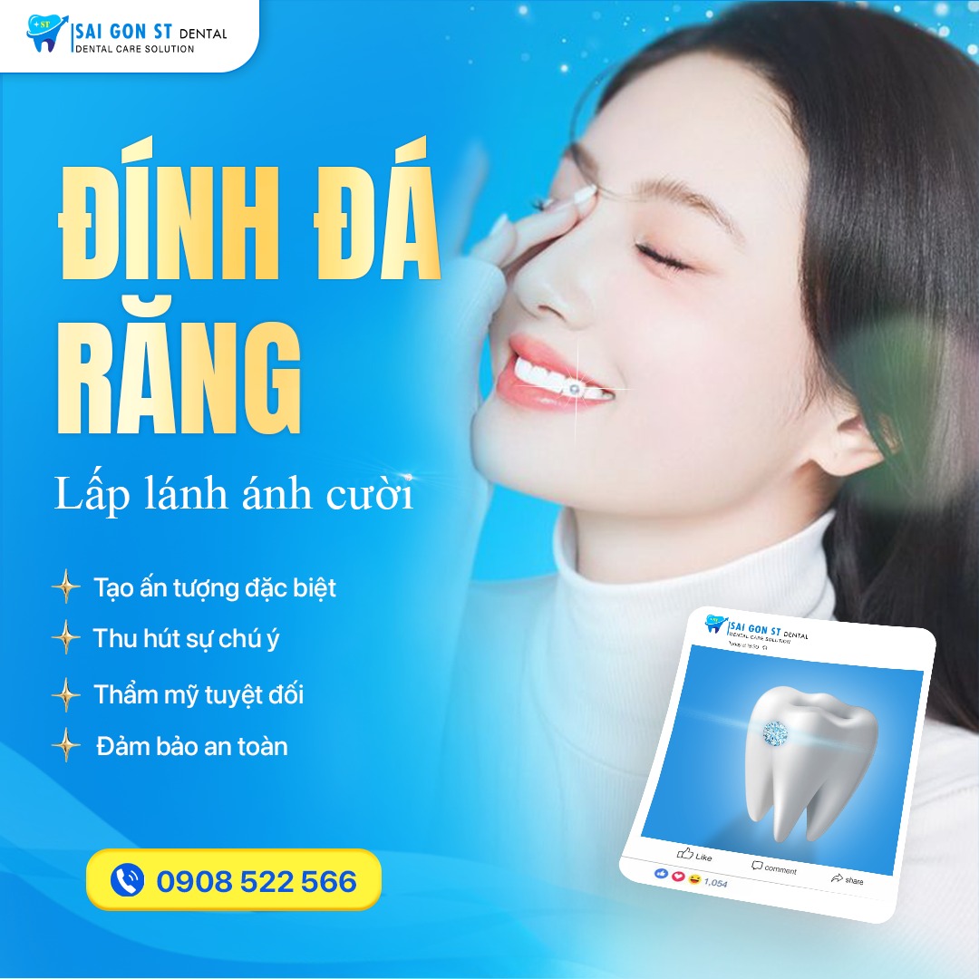 Đính Đá Răng Là Gì Có Nên Đính Đá Răng Không